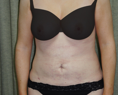 Vaser Liposuction Before and After Picture